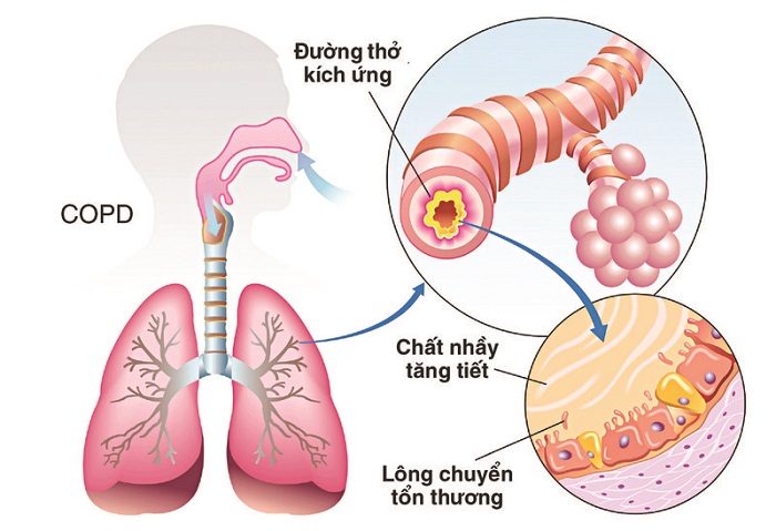 Bệnh COPD là một căn bệnh vô cùng nguy hiểm.