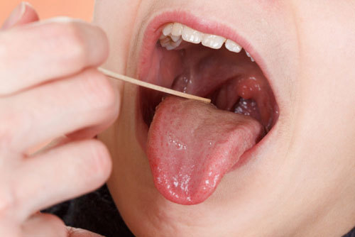 Rát lưỡi đau họng là gì?