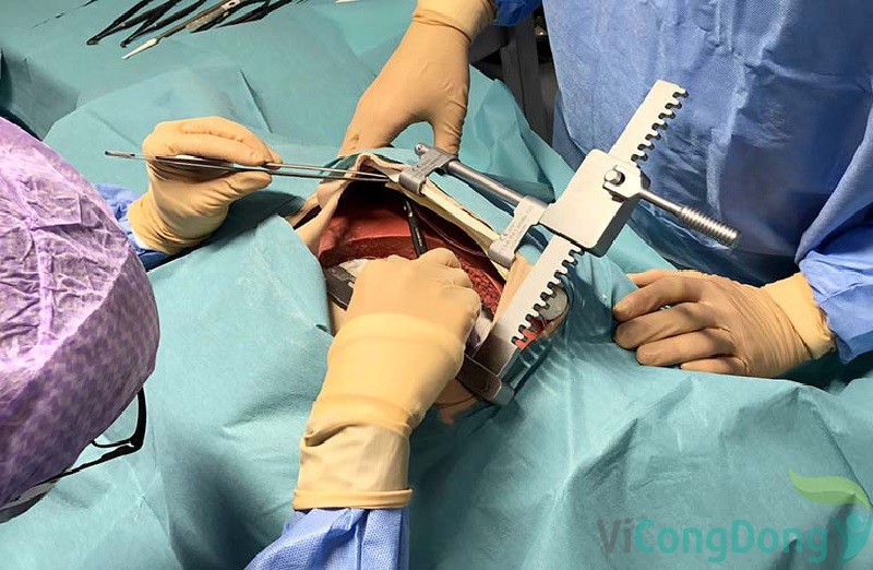 Kỹ thuật mổ thoát vị đĩa đệm ở bệnh viện Việt Đức