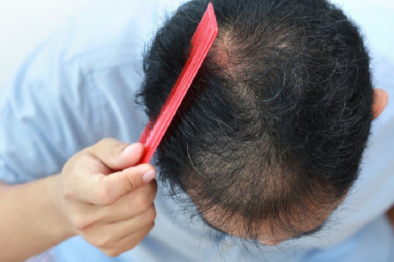 Cách nhận biết đàn ông yếu sinh lý - Lông tóc rụng nhiều
